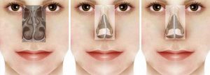 septum devuasyonu septoplasti